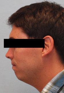 Before Results for Chin Implant