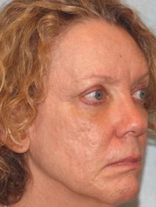 After Results for Blepharoplasty, Fat Transfer