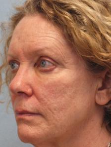 After Results for Blepharoplasty