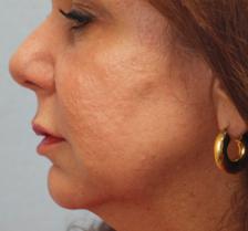 After Results for Laser Skin Resurfacing