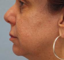 Before Results for Blepharoplasty