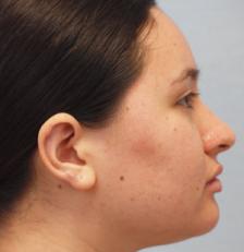After Results for Keloid Removal
