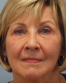 After Results for Laser Skin Resurfacing