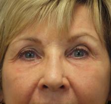 After Results for Laser Skin Resurfacing