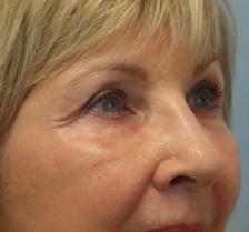 After Results for Laser Skin Resurfacing