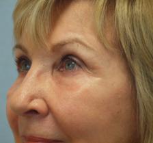 After Results for Laser Skin Resurfacing