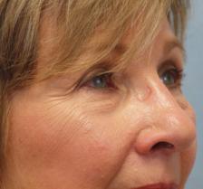Before Results for Laser Skin Resurfacing