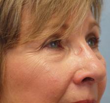 Before Results for Laser Skin Resurfacing