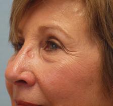 Before Results for Laser Skin Resurfacing