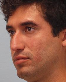 Before Results for Rhinoplasty