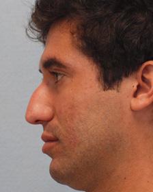 Before Results for Rhinoplasty