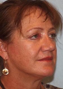 After Results for Facelift