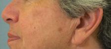 After Results for Laser Skin Resurfacing
