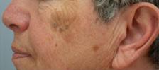 Before Results for Laser Skin Resurfacing