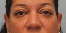 After Results for Blepharoplasty