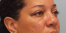 After Results for Blepharoplasty, Fat Transfer