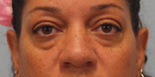 Before Results for Blepharoplasty