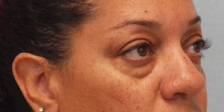 Before Results for Blepharoplasty