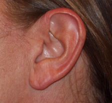 After Results for Earlobe Repair