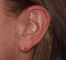 Before Results for Earlobe Repair