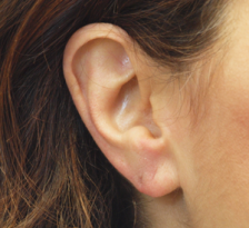 After Results for Earlobe Repair