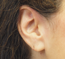 Before Results for Earlobe Repair