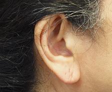 After Results for Earlobe Repair