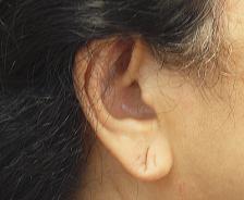 Before Results for Earlobe Repair