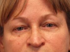 After Results for Botox, Restylane