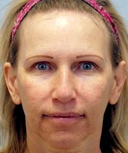 Before Results for Juvederm