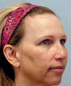 Before Results for Laser Skin Resurfacing