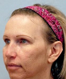 Before Results for Juvederm