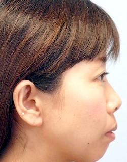 After Results for Earlobe Repair