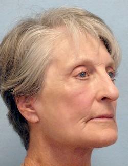 After Results for Laser Skin Resurfacing