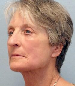 After Results for Facelift, Laser Skin Resurfacing, Fat Transfer, Necklift