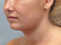 After Results for Neck Liposuction
