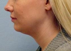 Before Results for Neck Liposuction