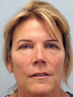 After Results for Blepharoplasty, Fat Transfer