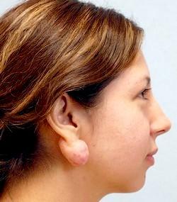 Before Results for Earlobe Repair