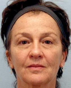 Before Results for Blepharoplasty