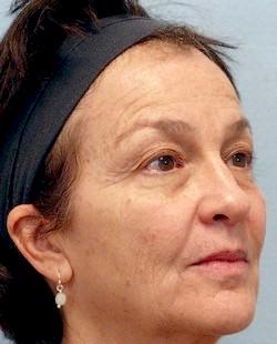 Before Results for Laser Skin Resurfacing