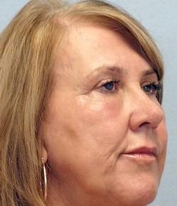 After Results for Blepharoplasty, Laser Skin Resurfacing, Fat Transfer