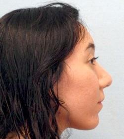 After Results for Rhinoplasty