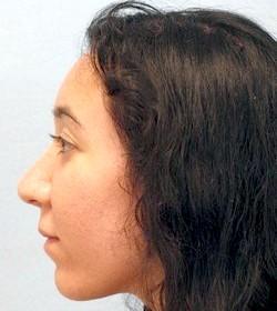 After Results for Rhinoplasty