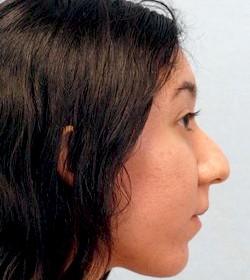 Before Results for Rhinoplasty