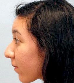 Before Results for Rhinoplasty