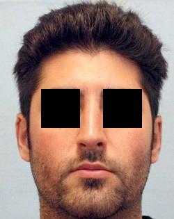 After Results for Rhinoplasty