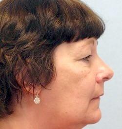 After Results for Mohs Surgery Reconstruction, Skin Cancer Reconstruction, Nose Reconstruction
