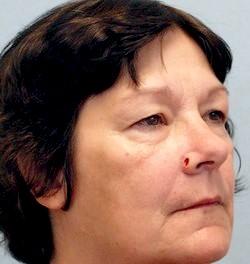 Before Results for Mohs Surgery Reconstruction, Skin Cancer Reconstruction, Nose Reconstruction