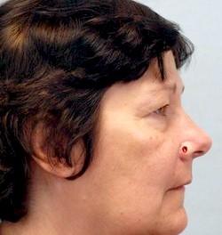 Before Results for Mohs Surgery Reconstruction, Skin Cancer Reconstruction, Nose Reconstruction